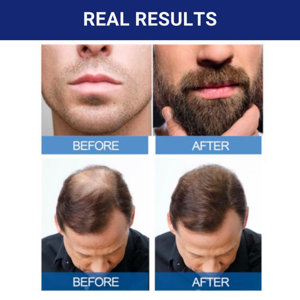 minoxidil